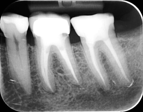 Radiographie dentaire