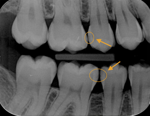 Radiographie de carie initiale