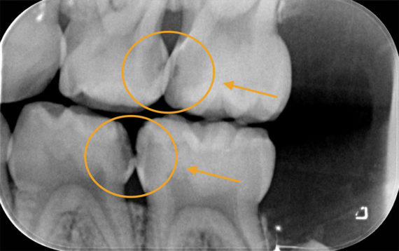 Radiographie d'une carie profonde