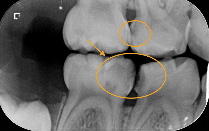 Radiographie d'une carie dentaire