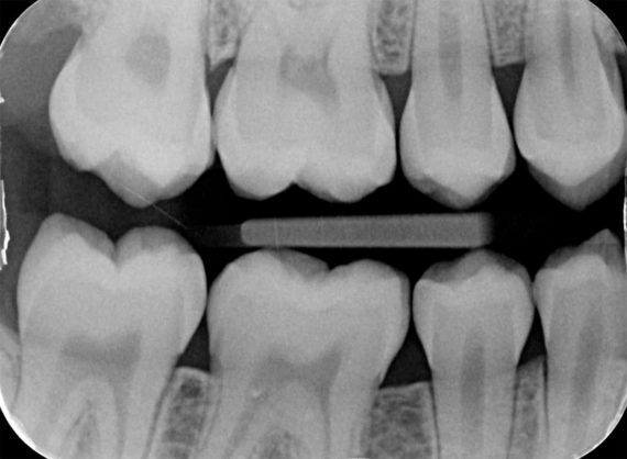 Radiographie de dents saines